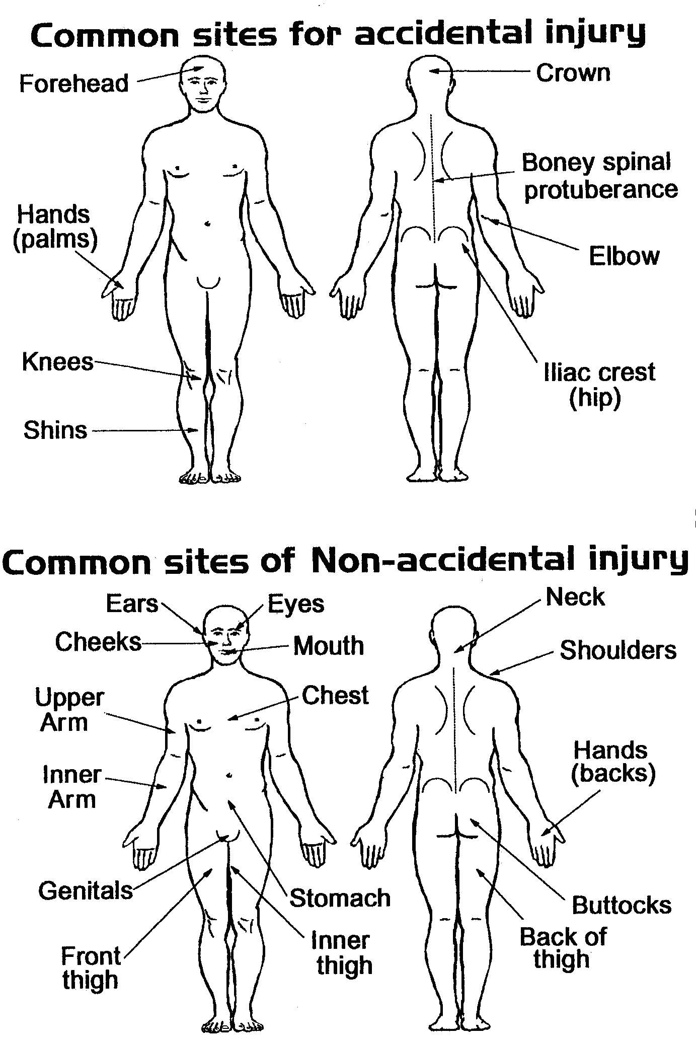Diagram showing typical sites of accidental injury, contrasted with sites of non-accidental injury